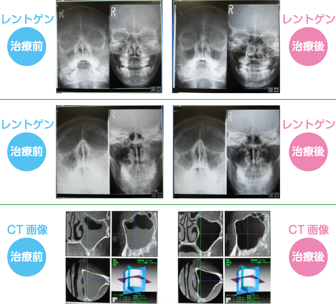 治っ 副 たか どうか 鼻腔 炎