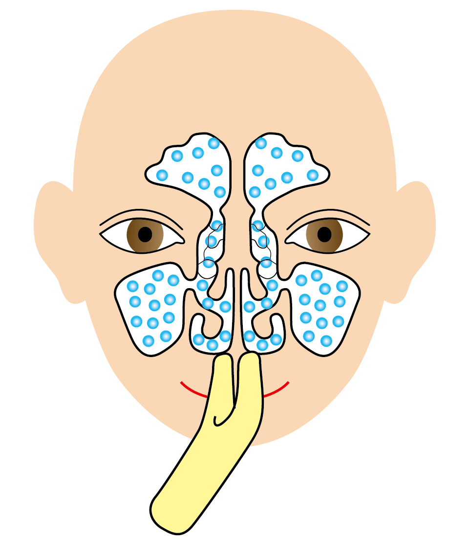 鼻腔 方 副 炎 治し 鼻づまりや鼻水だけじゃない慢性副鼻腔炎の症状・診断・治療法を解説