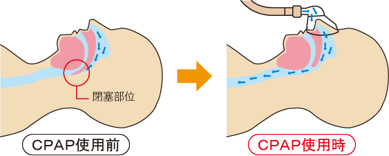 ＣＰＡＰ治療